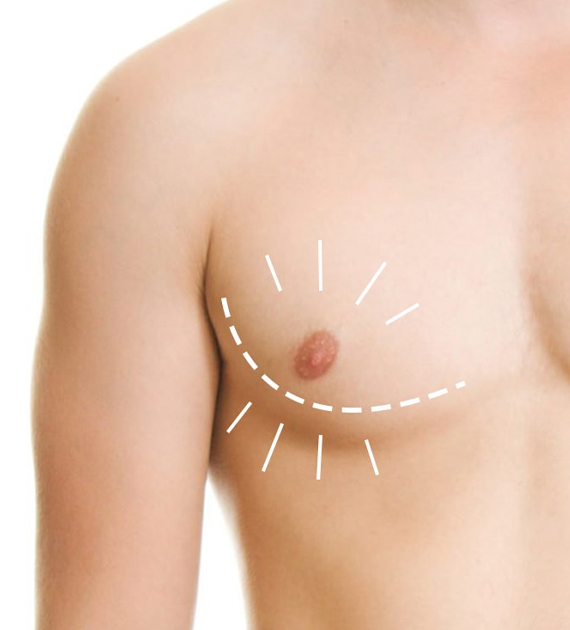 Gynecomastia Consultation Image